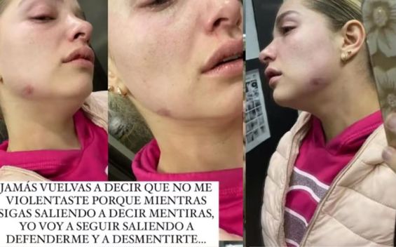 Surgen fotos de Sandra Itzel golpeada tras polémica de Adrián Di Monte