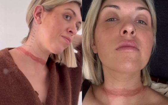influencer estuvo a punto de morir tras accidente con su bufanda