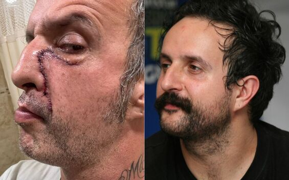 Antes y después de Tito Fuentes de Molotov tras 11 cirugías