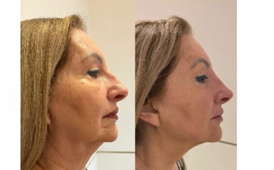 Doña Lety antes y después de su procedimiento estético