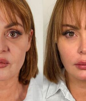 Gaby Spanic se hizo un tratamiento estético en Brasil (Instagram)