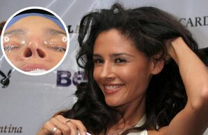 Dorismar muestra cómo luce su nariz tras amputación por mala cirugía (Instagram)