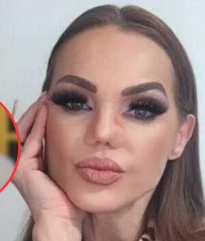 Carmen Campuzano se somete a nueva cirugía en su nariz