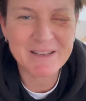 Andrea Plewig perdió la visión de un ojo tras manipular pirotecnia (Instagram @iam_andreaplewig)