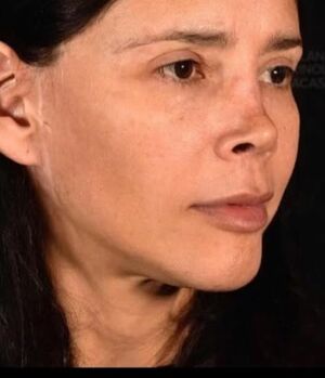 Así luce Dorismar tras una cuarta cirugía para arreglar su nariz (Instagram @froilanpaez)