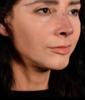 Así luce Dorismar tras una cuarta cirugía para arreglar su nariz (Instagram @froilanpaez)