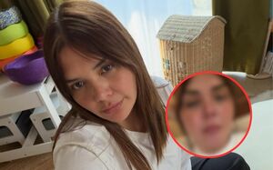 Yuridia genera preocupación tras sufrir una quemadura en el rostro