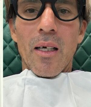 Esto se sabe sobre el accidente de Fernando Reina que lo dejó chimuelo (Instagram)