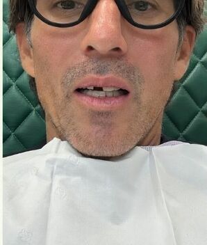 Esto se sabe sobre el accidente de Fernando Reina que lo dejó chimuelo (Instagram)