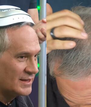 Arath de la Torre se somete a tratamiento contra la alopecia (Foto: Instagram)