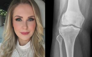 La actriz Ingrid Martz se alista para solucionar un problema en las rodillas (Instagram)
