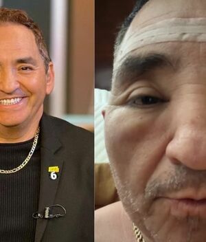 Ernesto Chavana aparece con el rostro desfigurado por box (Instagram)