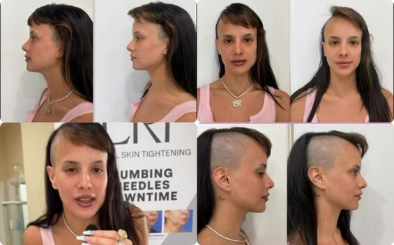 Gala Montes se somete a procedimiento estético en el rostro