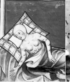 Peste neumónica: Conoce los síntomas de esta mortal enfermedad (Instagram)